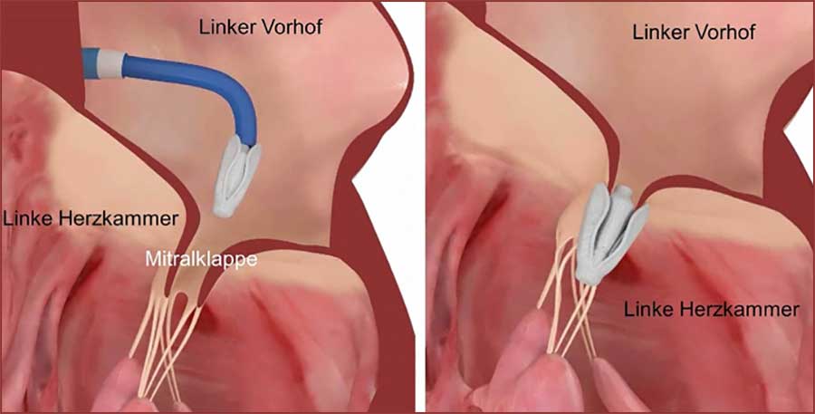 Klappen-Rekonstruktionssystem-PASCAL Bild: ©Edwards Lifesciences