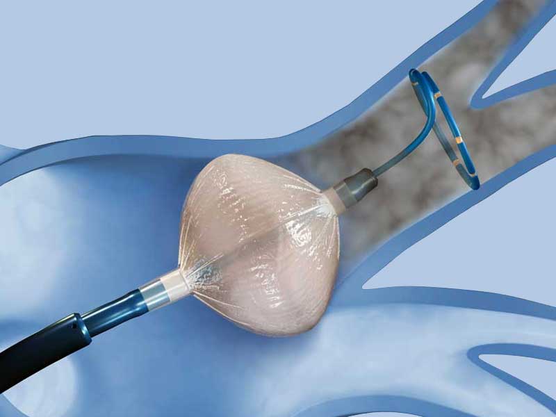 KC Leistungen Vorhofflimmern Ablation