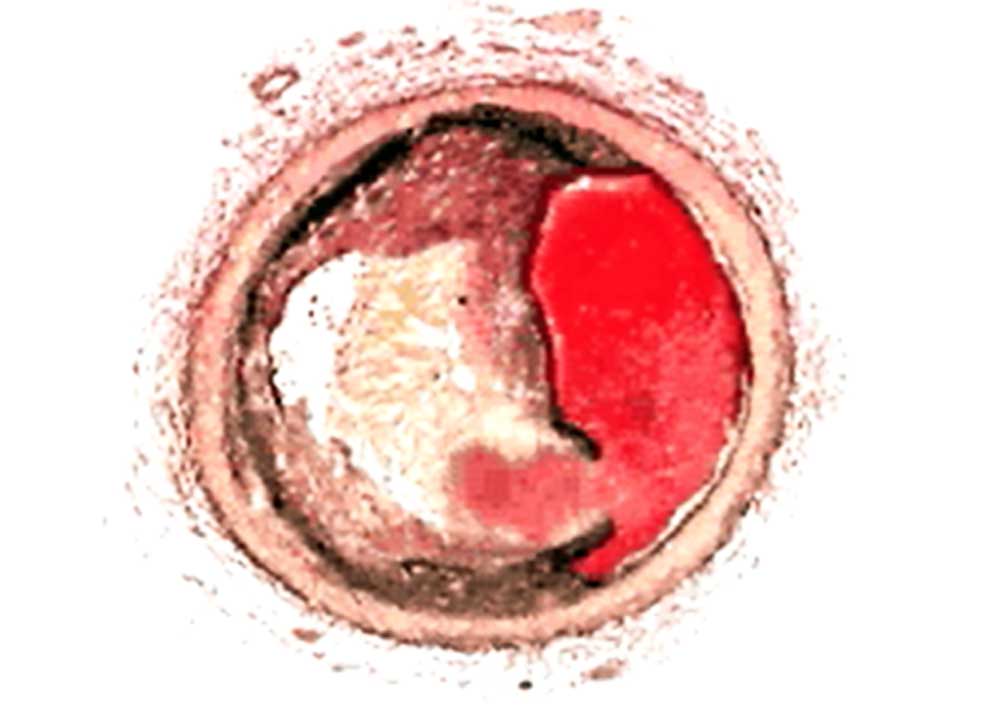 Thrombolyse