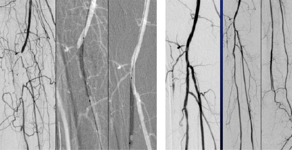 Angiographie-Aufnahmen der Beinarterien
