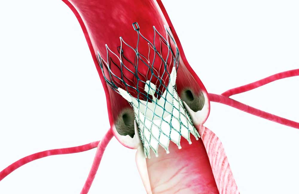 TAVI CoreValve Aortenklappenprothese